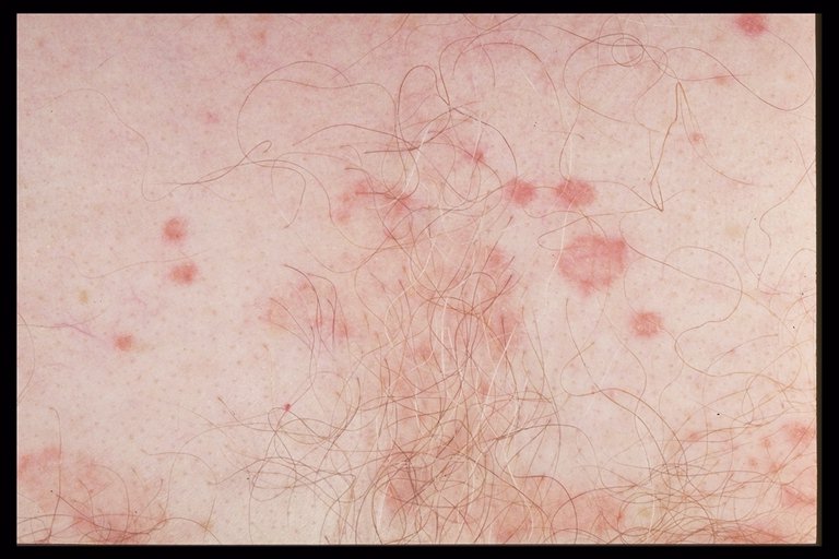 Eczema on my breasts has made my nipples itchy and sore.
