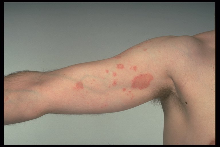 Picture of Nummular Eczema - WebMD